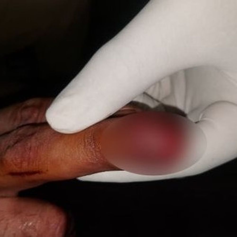 यमुनानगर में पुलिस टीम पर हमले का मामला:आरोपियों को आज कोर्ट में किया जाएगा पेश, फरार खैर तस्कर की तलाश में लगी टीमें